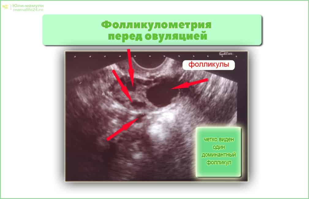 Фолликулометрия перед овуляцией