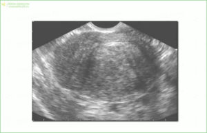 Эндовагинальная и брюшная сонограмма (УЗИ)