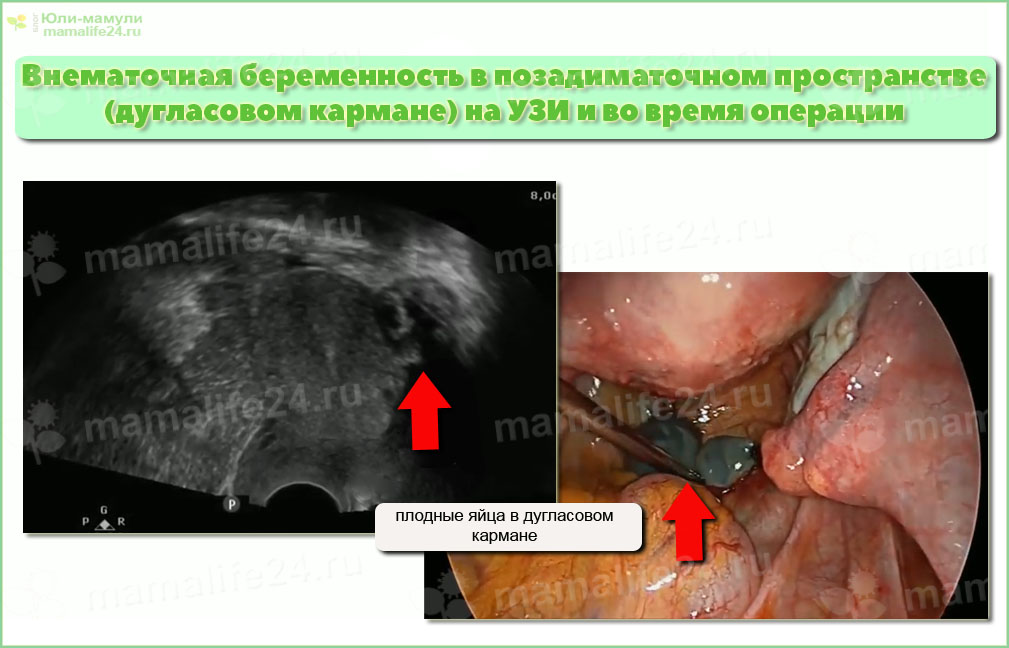 Фото Внематочной Беременности На Ранних Сроках